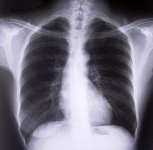 Máte podozrenie na obštruktívnu bronchitídu? Príznaky by mali byť známe všetkým