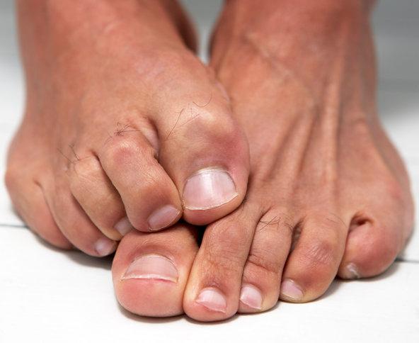Nezdravá huba na nechtoch nohy: liečba ľudovými prostriedkami